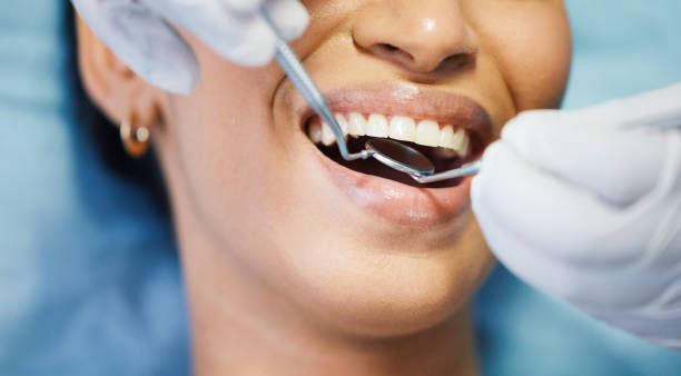 Best Emergency Wisdom Teeth Removal in Belfair, WA